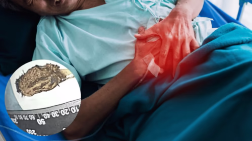 Man Lives 52 Years With Toothbrush Swallowed as a Child