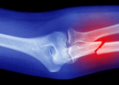 Revolutionary Breakthrough: Chinese Scientists Develop a Glueless Solution for Broken Bones