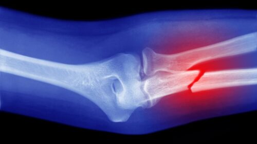 Revolutionary Breakthrough: Chinese Scientists Develop a Glueless Solution for Broken Bones