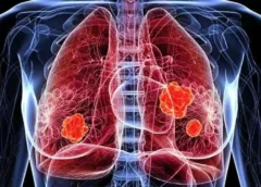 New Hope for Lung Cancer Patients: Promising Study from China