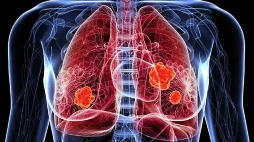 New Hope for Lung Cancer Patients: Promising Study from China