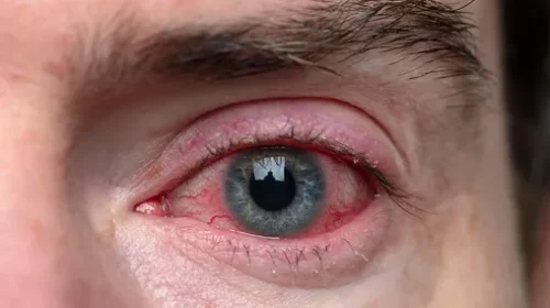 Can an Eye Exam Detect Heart Problems?