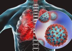 Postural Orthostatic Tachycardia Syndrome (POTS) is Highly Prevalent in Long COVID Patients: New Research