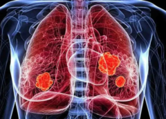 Cancer : UK Scientists Develop Blood Test to Detect Lung Cancer at Early Stage