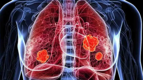 Cancer : UK Scientists Develop Blood Test to Detect Lung Cancer at Early Stage