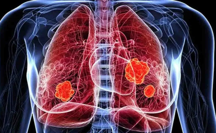 Cancer : UK Scientists Develop Blood Test to Detect Lung Cancer at Early Stage