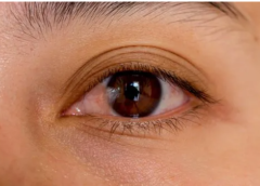 Indian Scientists Develop New Peptide Therapy for Fungal Keratitis Treatment